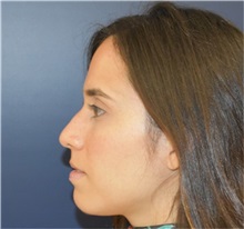 Rhinoplasty Before Photo by Richard Reish, MD, FACS; New York, NY - Case 33193