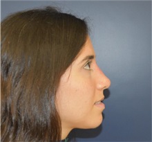 Rhinoplasty After Photo by Richard Reish, MD, FACS; New York, NY - Case 33193