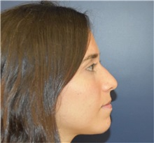 Rhinoplasty Before Photo by Richard Reish, MD, FACS; New York, NY - Case 33193