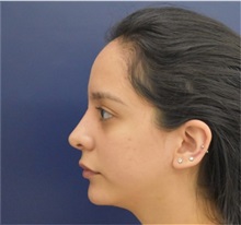 Chin Augmentation After Photo by Richard Reish, MD, FACS; New York, NY - Case 33194