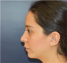 Chin Augmentation Before Photo by Richard Reish, MD, FACS; New York, NY - Case 33194