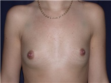 Breast Augmentation Before Photo by Gary Culbertson, MD, FACS; Sumter, SC - Case 33320