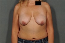 Breast Lift Before Photo by Ellen Janetzke, MD; Bloomfield Hills, MI - Case 33365