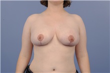 Breast Reduction After Photo by Katerina Gallus, MD, FACS; San Diego, CA - Case 33444