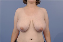 Breast Reduction Before Photo by Katerina Gallus, MD, FACS; San Diego, CA - Case 33444