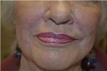 Dermal Fillers After Photo by Joe Griffin, MD; Florence, SC - Case 33517