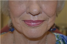 Dermal Fillers Before Photo by Joe Griffin, MD; Florence, SC - Case 33517