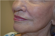 Dermal Fillers After Photo by Joe Griffin, MD; Florence, SC - Case 33517