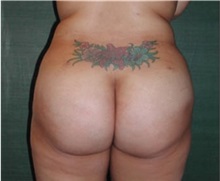 Buttock Lift with Augmentation After Photo by Steven Wallach, MD; New York, NY - Case 33641