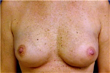 Breast Reconstruction After Photo by Matthew Kilgo, MD, FACS; Garden City, NY - Case 33869