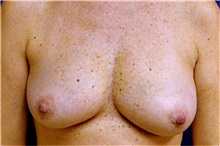 Breast Reconstruction Before Photo by Matthew Kilgo, MD, FACS; Garden City, NY - Case 33869