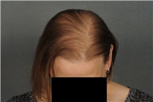 Hair Transplant After Photo by Ellen Janetzke, MD; Bloomfield Hills, MI - Case 33899