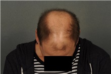 Hair Transplant Before Photo by Ellen Janetzke, MD; Bloomfield Hills, MI - Case 33899