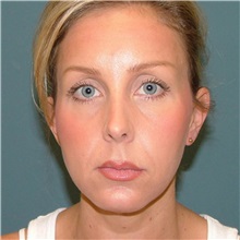 Chin Augmentation After Photo by Arturo Guiloff, MD; Palm Beach Gardens, FL - Case 34071