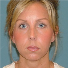 Chin Augmentation Before Photo by Arturo Guiloff, MD; Palm Beach Gardens, FL - Case 34071