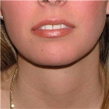 Chin Augmentation After Photo by Arturo Guiloff, MD; Palm Beach Gardens, FL - Case 34072