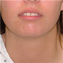 Chin Augmentation Before Photo by Arturo Guiloff, MD; Palm Beach Gardens, FL - Case 34072