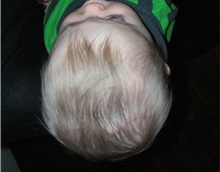 Craniosynostosis After Photo by Rachel Ruotolo, MD; Garden City, NY - Case 34080