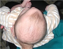 Craniosynostosis Before Photo by Rachel Ruotolo, MD; Garden City, NY - Case 34080