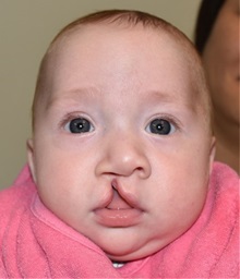 Cleft Lip and Palate Repair Before Photo by Rachel Ruotolo, MD; Garden City, NY - Case 34160