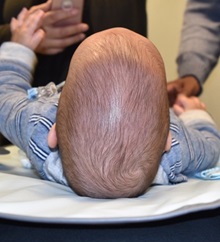 Craniosynostosis Before Photo by Rachel Ruotolo, MD; Garden City, NY - Case 34161