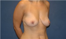 Breast Lift Before Photo by Scott Sattler, MD,  FACS; Seattle, WA - Case 34346