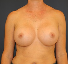 Breast Augmentation After Photo by Steve Laverson, MD, FACS; Rancho Santa Fe, CA - Case 34523