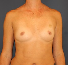 Breast Augmentation Before Photo by Steve Laverson, MD, FACS; Rancho Santa Fe, CA - Case 34523