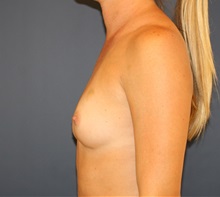 Breast Augmentation Before Photo by Steve Laverson, MD, FACS; Rancho Santa Fe, CA - Case 34523