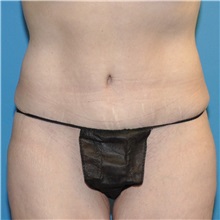 Tummy Tuck After Photo by Joshua Cooper, MD; Seattle, WA - Case 34586