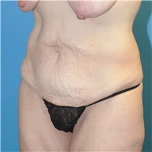 Tummy Tuck Before Photo by Joshua Cooper, MD; Seattle, WA - Case 34586