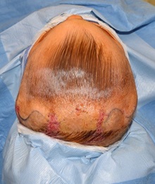 Craniosynostosis Before Photo by Rachel Ruotolo, MD; Garden City, NY - Case 34814