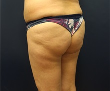 Buttock Lift with Augmentation Before Photo by Laurence Glickman, MD, MSc, FRCS(c),  FACS; Garden City, NY - Case 34868