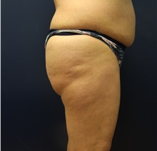 Buttock Lift with Augmentation Before Photo by Laurence Glickman, MD, MSc, FRCS(c),  FACS; Garden City, NY - Case 34868