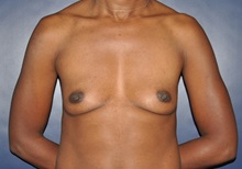 Breast Reconstruction Before Photo by Jerry Weiger Chang, MD, FACS; Flushing, NY - Case 35002