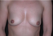 Breast Augmentation Before Photo by Frederick Lukash, MD, FACS, FAAP; East Hills, NY - Case 35057