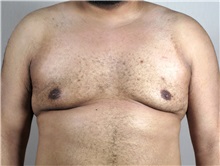 Male Breast Reduction After Photo by Paul Parker, MD; Paramus, NJ - Case 35100