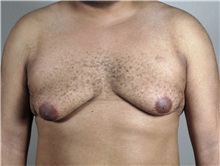 Male Breast Reduction Before Photo by Paul Parker, MD; Paramus, NJ - Case 35100