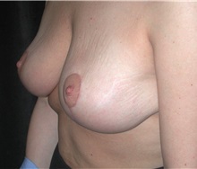 Breast Lift After Photo by Frederick Lukash, MD, FACS, FAAP; East Hills, NY - Case 35118