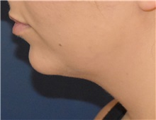 Chin Augmentation Before Photo by Richard Reish, MD, FACS; New York, NY - Case 35333