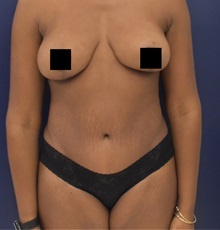 Liposuction After Photo by Richard Reish, MD, FACS; New York, NY - Case 35338