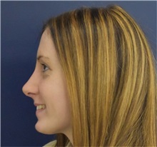 Rhinoplasty After Photo by Richard Reish, MD, FACS; New York, NY - Case 35403