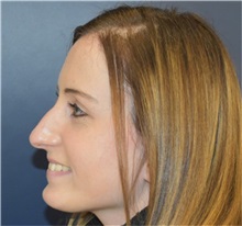 Rhinoplasty Before Photo by Richard Reish, MD, FACS; New York, NY - Case 35403