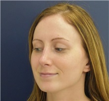 Rhinoplasty After Photo by Richard Reish, MD, FACS; New York, NY - Case 35403