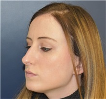 Rhinoplasty Before Photo by Richard Reish, MD, FACS; New York, NY - Case 35403