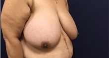 Breast Reduction Before Photo by Brian Pinsky, MD, FACS; Huntington Station, NY - Case 35471