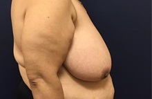 Breast Reduction Before Photo by Brian Pinsky, MD, FACS; Huntington Station, NY - Case 35471