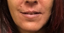 Lip Augmentation/Enhancement Before Photo by Brian Pinsky, MD, FACS; Huntington Station, NY - Case 35491