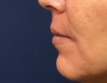 Lip Augmentation/Enhancement Before Photo by Brian Pinsky, MD, FACS; Huntington Station, NY - Case 35491