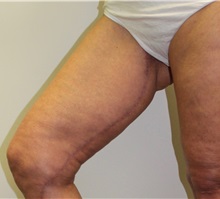 Thigh Lift After Photo by James Lee, MD; Laval, QC - Case 35566